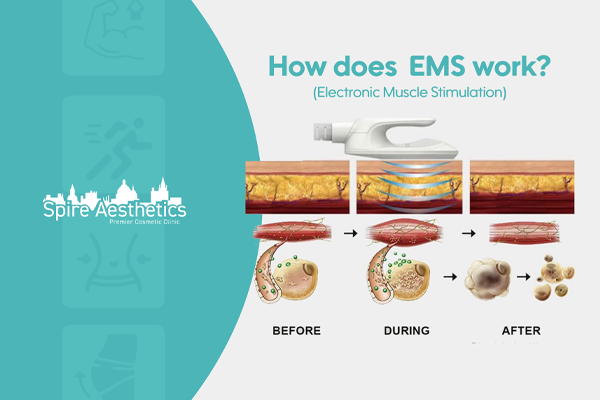 EMS treatment for post pregnancy weight loss treatment Blackheath