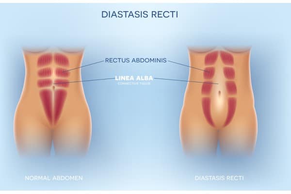 What Non-Surgical Options Are Available for Diastasis Recti Blackheath?