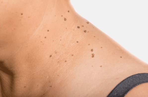 Are you looking for easy skin tag removal Blackheath - then contact Spire today!