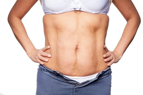 sagging skin on woman's stomach after weight loss injections Blackheath