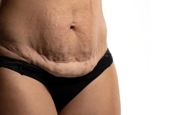 Image of womans stomach after weight loss injections Blackheath showing saggy skin